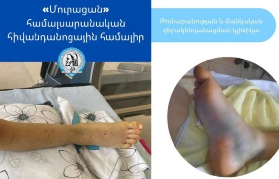 12-летнего мальчика в Армении ужалила гюрза, он был госпитализирован в тяжелом состоянии