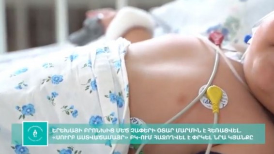 «Սուրբ Աստվածամայր» ԲԿ-ում 10 ամսական երեխայի բրոնխից մեծ չափերի օտար մարմին է հեռացվել